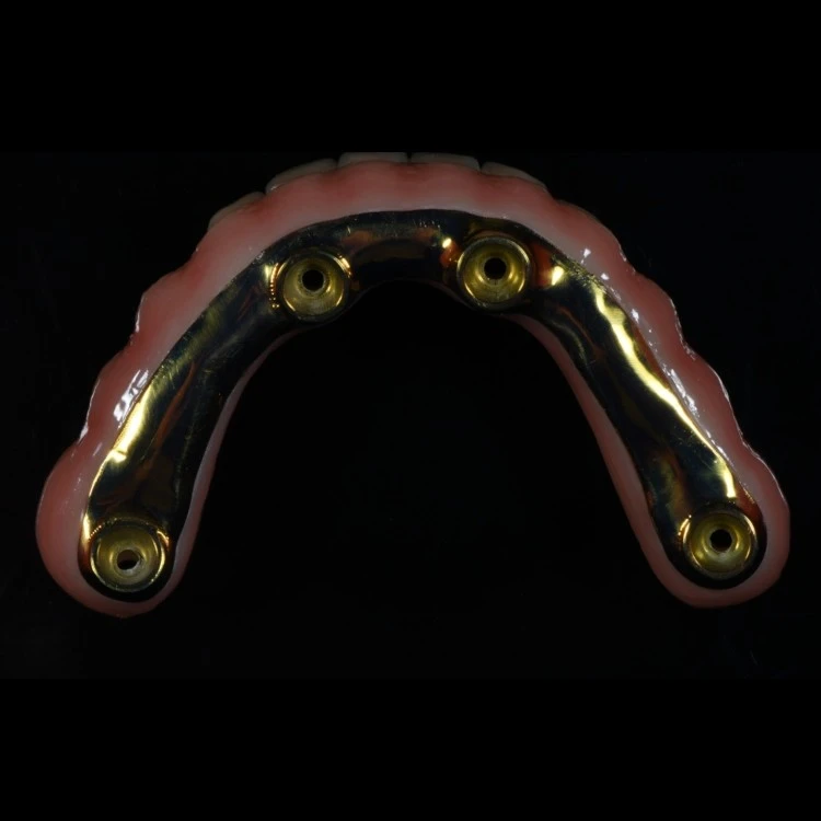 All-on-X Implant Bridge high quality