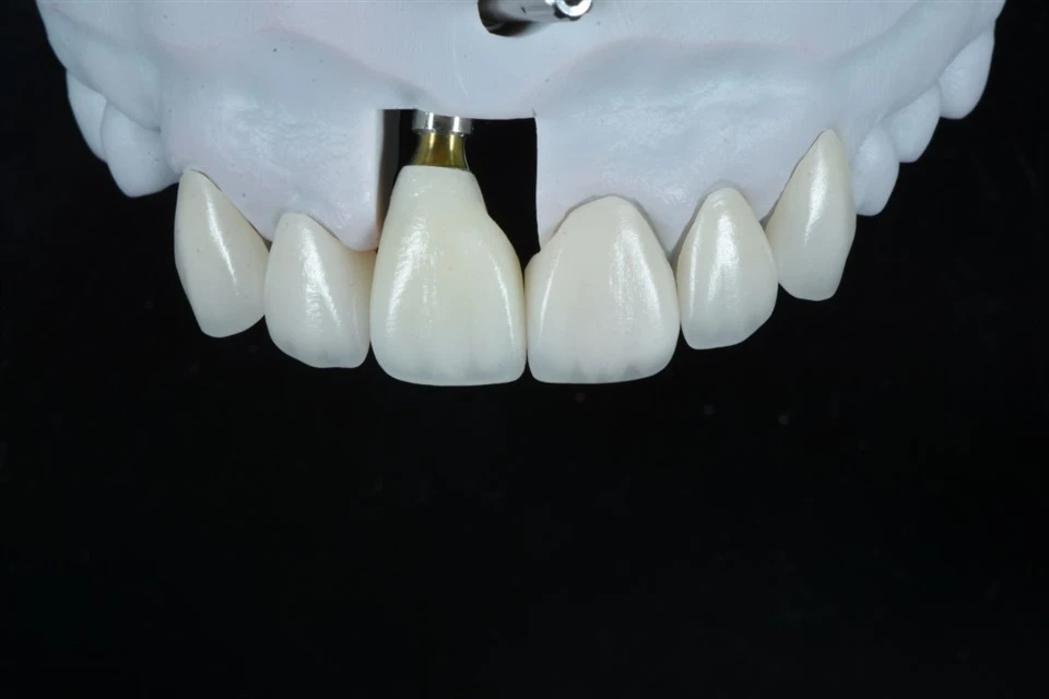Implant Crown Compatible With Major Implant Systems
