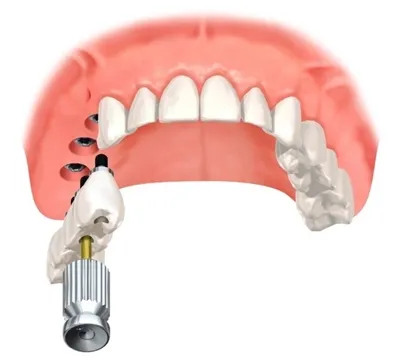 What Is a Screw-Retained Implant Crown?