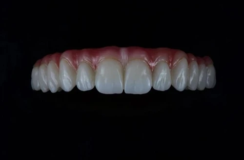 Crown Margin Design: Shoulder vs Chamfer