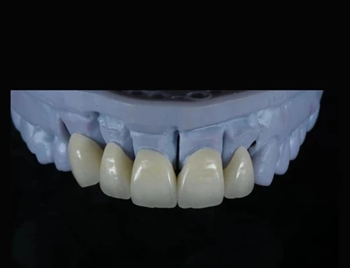 How Professional Dental Labs Ensure Perfect Crown Fit Every Time