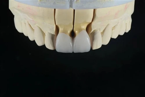 How to Improve Crown Fit and Accuracy