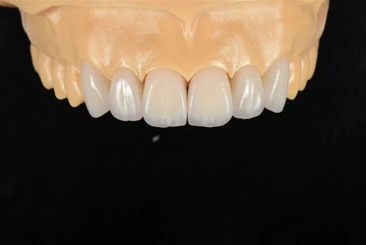 Lithium Disilicate Veneer Lithium Disilicate Veneer