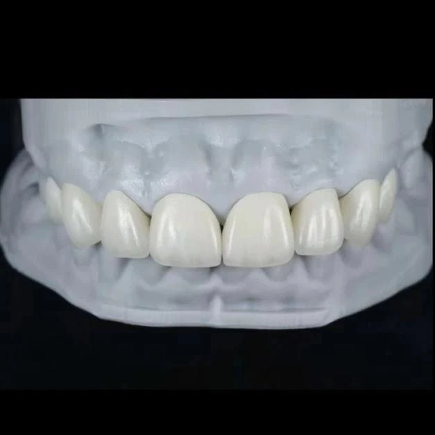 E.max Layered Veneer E.max Layered Veneer