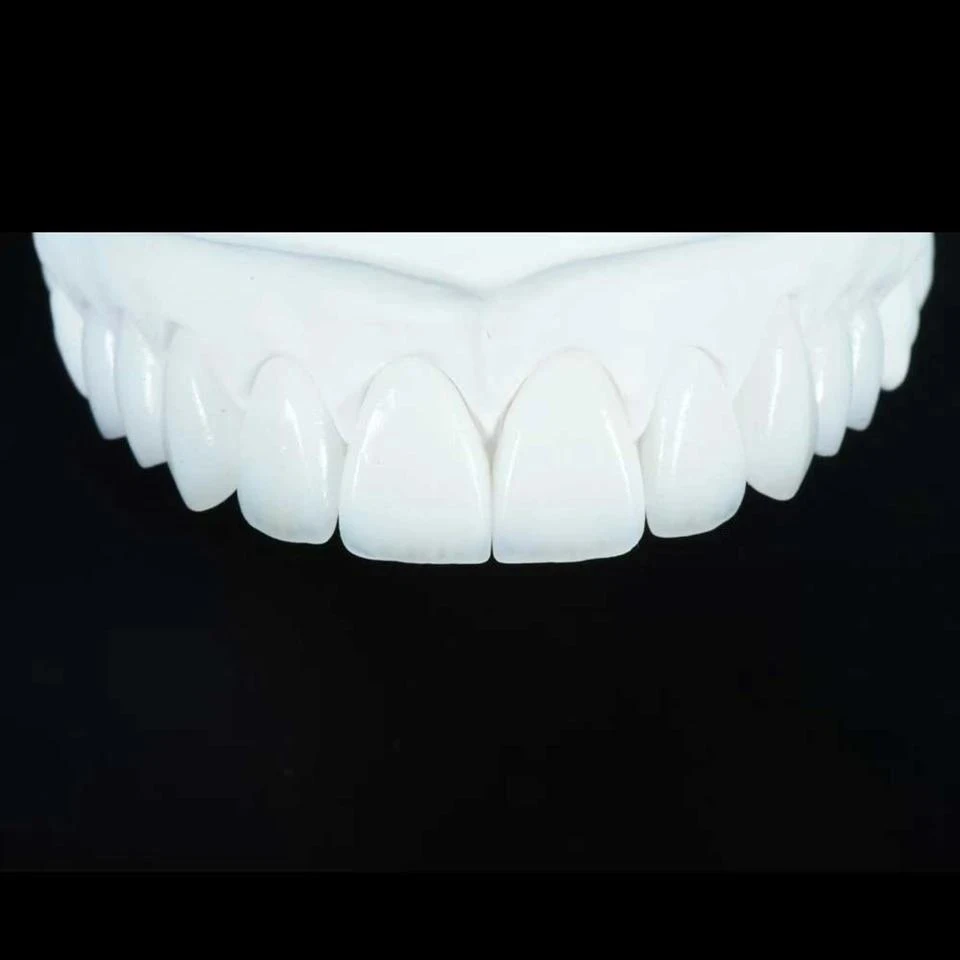 Emax Monolithic Veneer Emax Monolithic Veneer