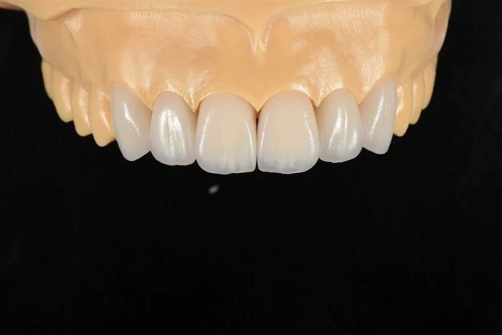 Lithium Disilicate Veneer Lithium Disilicate Veneer