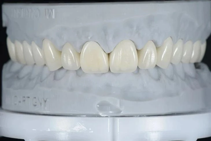 Pressed E-max Crown Pressed E-max Crown