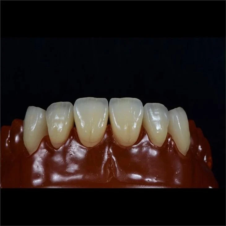Layered Zirconia Crown Layered Zirconia Crown