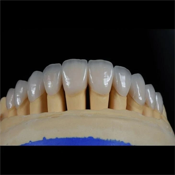 Feldspathic Porcelain Veneers Feldspathic Porcelain Veneers