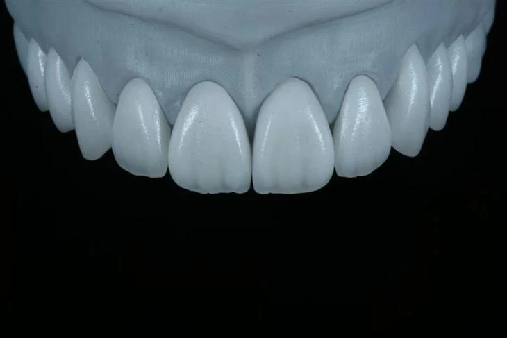 Hand-Layered E.max Veneers Hand-Layered E.max Veneers