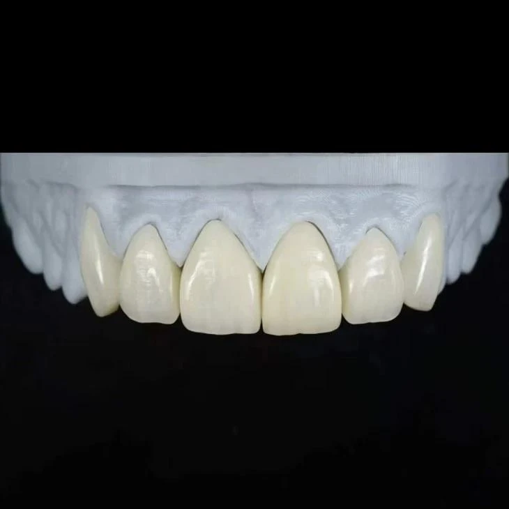 /fixed-restorations/dental-veneers/e-max-press-monolithic-veneers.html /fixed-restorations/dental-veneers/e-max-press-monolithic-veneers.html