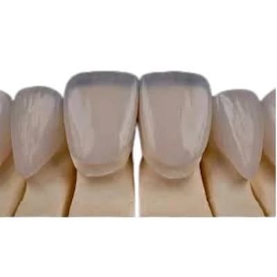 Dental Veneers