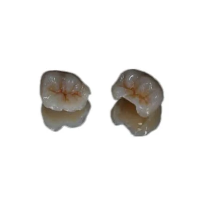 Inlay&Onlay