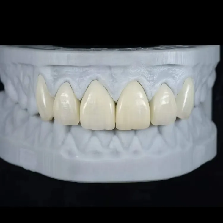 Natural Aesthetic Veneers With Strength And Precision