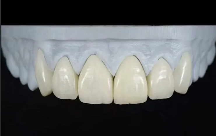 natural looking veneers natural looking veneers
