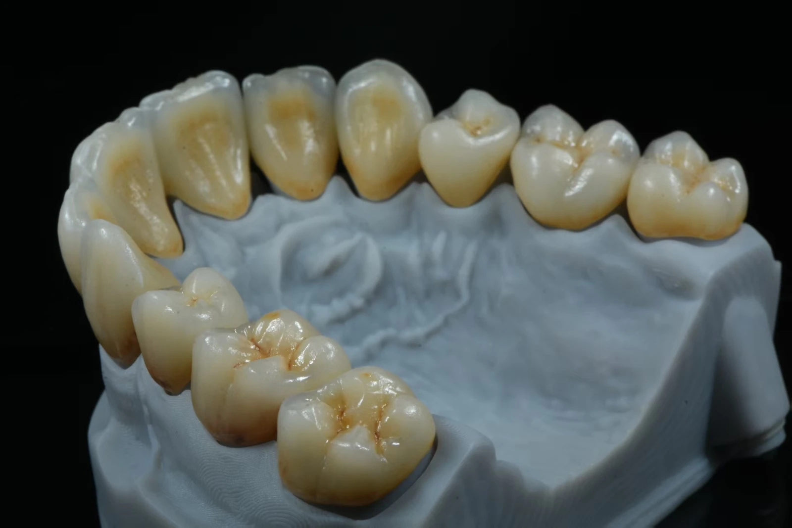 High-strength zirconia molar crown for teeth grinding cases High-strength zirconia molar crown for teeth grinding cases