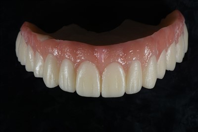 Acrylic Resin Temporary Crown