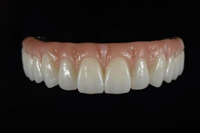 Digitally Designed All-on-X Zirconia Bridge