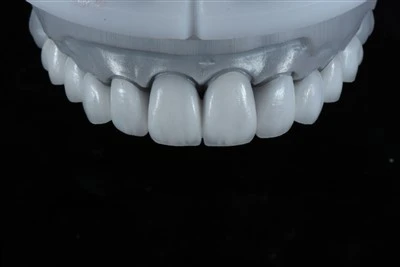 Digitally Designed E.max Layering Veneers
