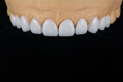 E.max Layering Veneers With Natural Shade Transition