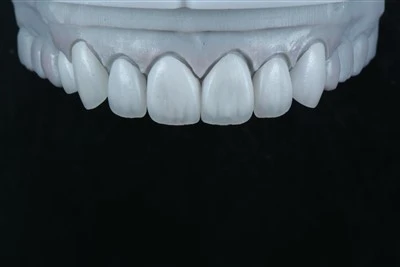E.max Layering Veneers With Surface Texture