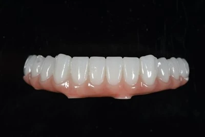 Mandibular All-on-X Zirconia Bridge
