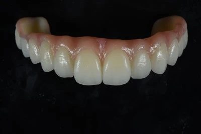Metal-Free All-on-X Zirconia Bridge