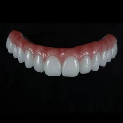 Metal-Free All-on-X Zirconia Bridge