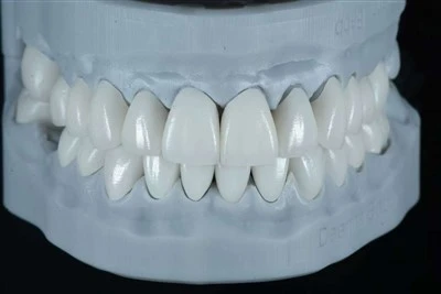 Minimal-Prep E.max Layering Veneers