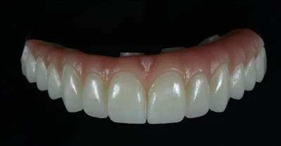 Pink Gingiva Full Arch Zirconia Bridge